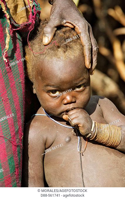 Surma child victim of kwashiorkor, a type of childhood malnutrition. Near Kibish. Ethiopia