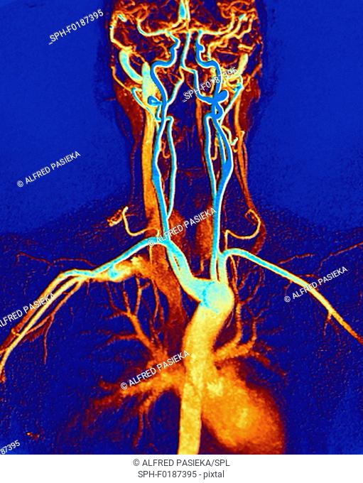 Chest, neck and head arteries. Coloured magnetic resonance angiography (MRA) scan of a normal carotid system of a 45 year old female