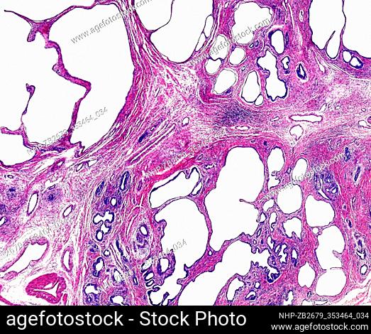 Light micrograph section through a human prostate gland showing a prostate carcinoma