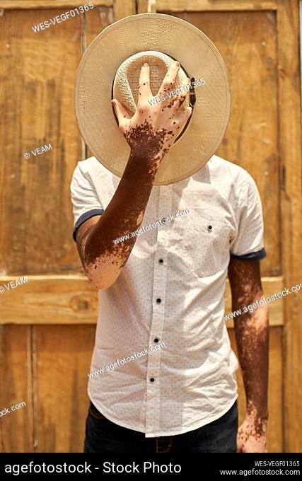 Portrait of young man with vitiligo covering his face with a hat