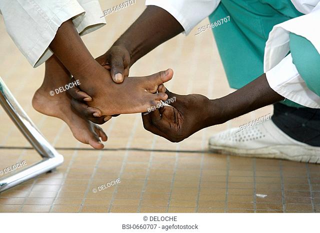 Photo essay in a hospital in Congo consultation of the Chain of Hope. Foot malformation of a child