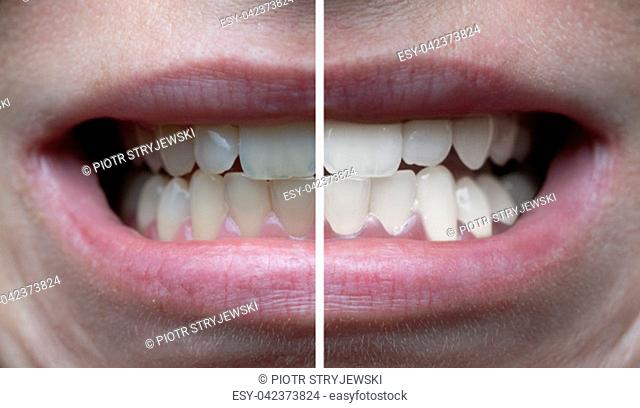Closeup of woman's teeth before and after whitening