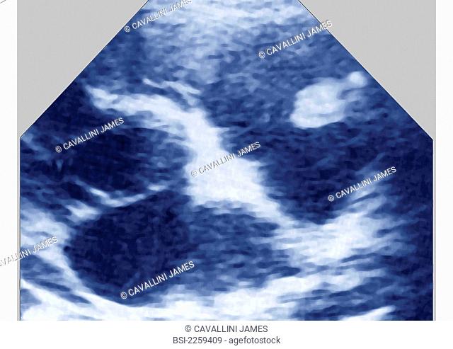 Vegetation microbial cluster, in pink in the trunk of the pulmonary artery - Cardiac ultrasound