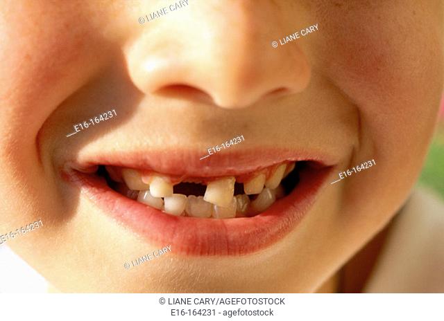 Boy missing tooth