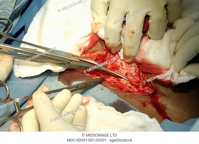 The anterior rectus sheath is incised using curved Mayo scissors