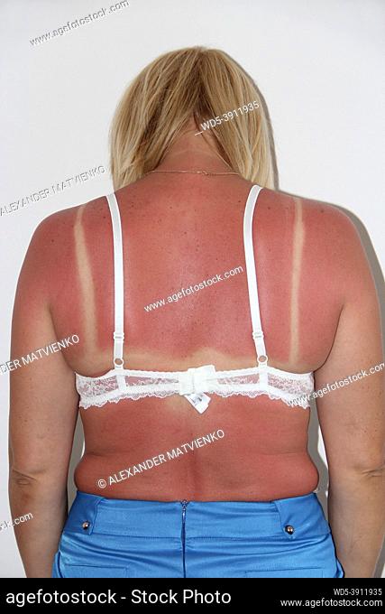 Sunburn from beach sun light on shoulder and back of caucacian girl. Woman sunburn. Female body. Body care. Sunburn on female back