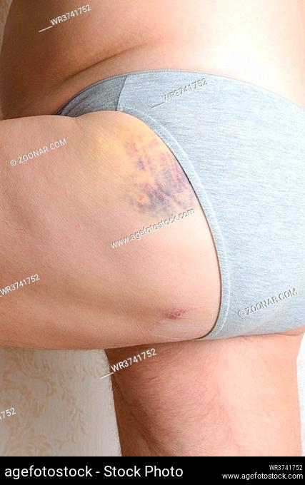 Man injured by dog bites in the buttock. The deep wounds left by the fangs are obvious. A blue hematoma covers the leg