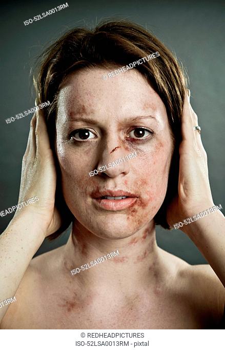 Woman with bruises covering her ears