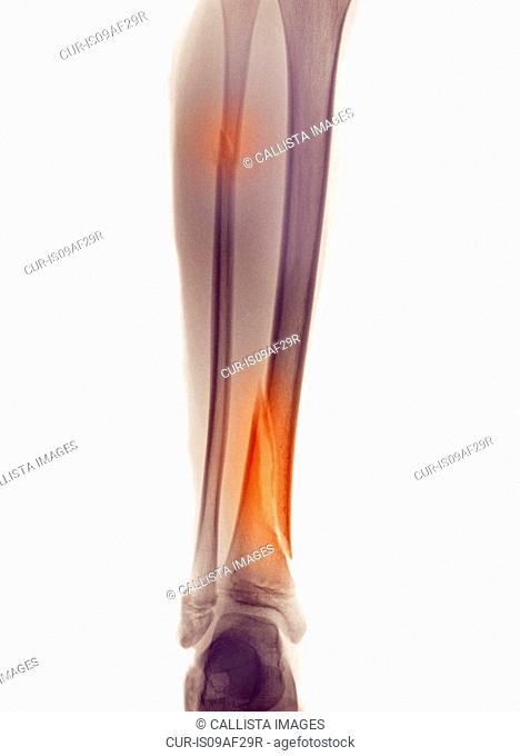 X-ray of leg showing fracture of fibula and tibia