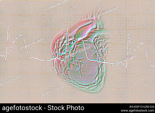 Myocardial infarction. Visualization by electrocardiogram