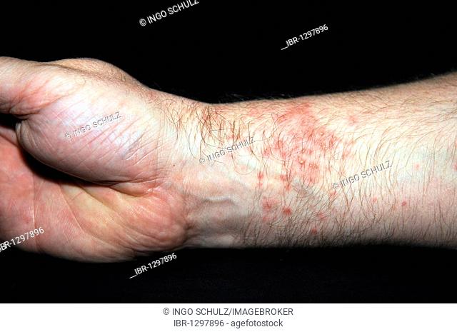 Very red, blistered skin, hives or urticaria after contact with sea anemones (Heteractis spec.)