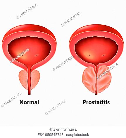 H a prostatitisből - Mi mit jelent a prosztatarák patológiai leletén?
