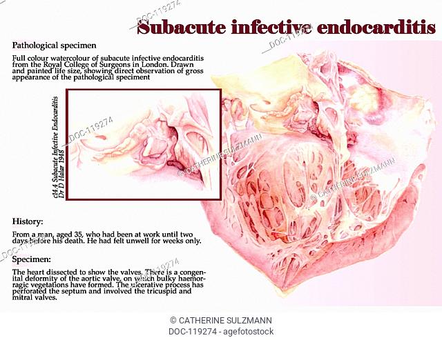 subacute endocarditis
