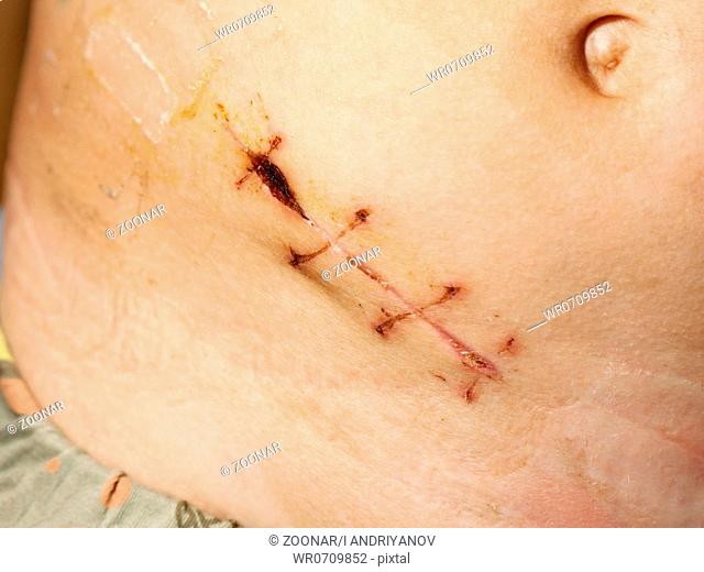 Appendix removal surgical suture
