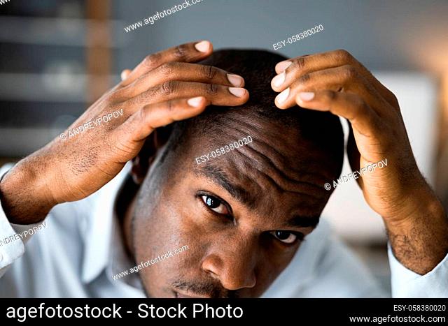 Young African Men Hair Loss. Watching Hairloss