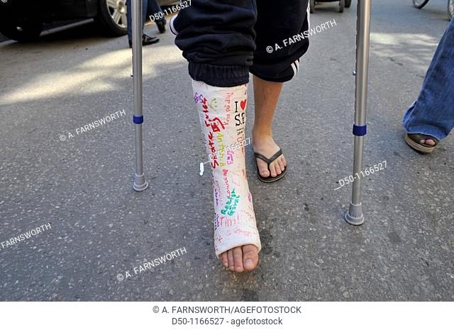 Boy with crutches and a broken leg with a cast, Stockholm, Sweden