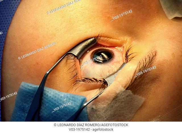 Corrective Eye Surgery