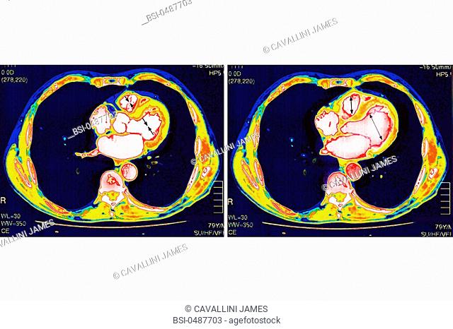 HEART, SCAN<BR>Systolic (at left) and diastolic (at right) movements of the heart's ventricles. Thoracic CT scan of coronary cavities and lungs