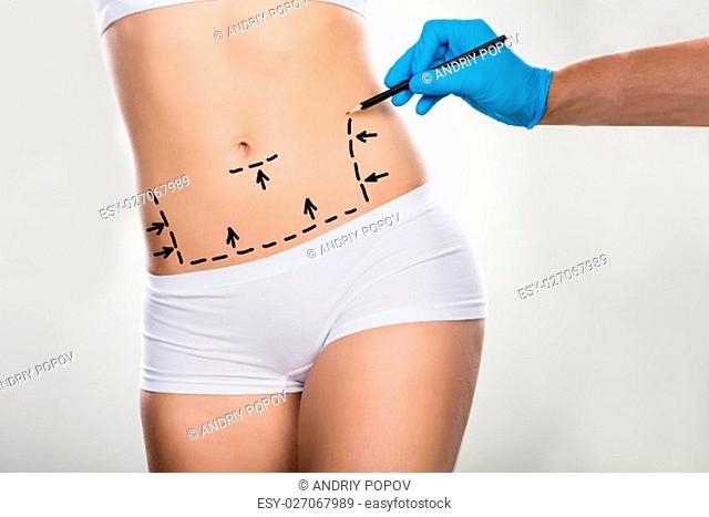 Close-up Of A Surgeon Drawing Correction Lines On Woman's Stomach