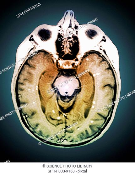 Secondary brain cancer. Coloured magnetic resonance imaging MRI scan of an axial section through the brain of a 45 year old patient showing numerous malignant...