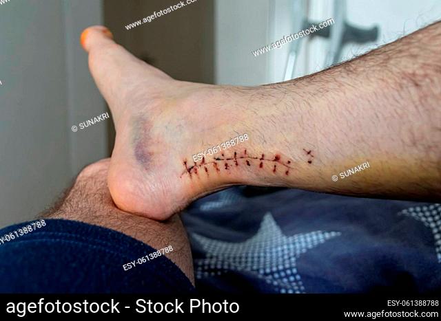 Wound suture after Achilles tendon rupture operation is treated and checked by doctor in the hospital showing stitches and operation transection with effusion...