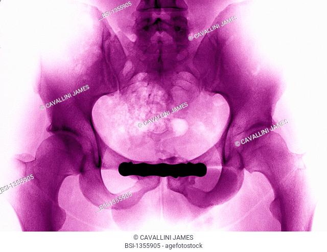 TRANSVERSE FRACTURE PUBIS, X-RAY<BR>Surgical plate used to treat a pubic disruption. Frontal pelvic x-ray