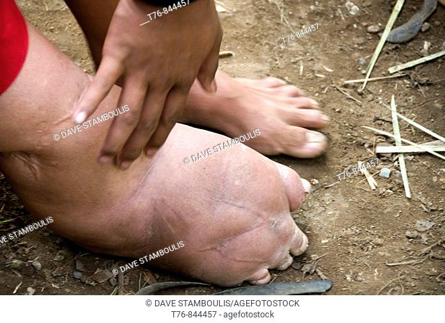 elephantiasis of the foot on a Karen refugee from Burma