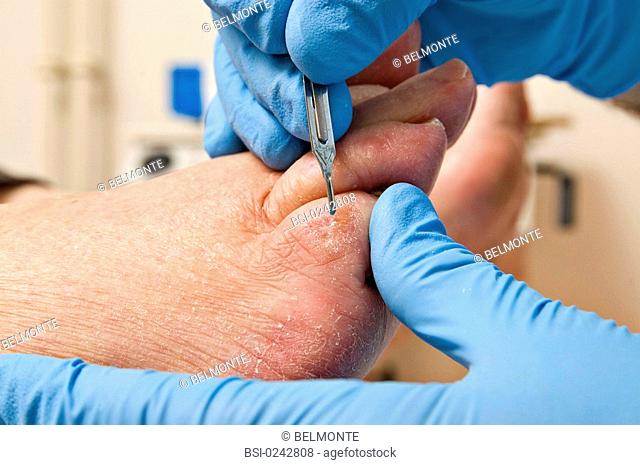 Photo essay from hospital. Pedicure care at the Corentin Celton hospital Issy-les-Moulineaux, France on the corn of a diabetic patient's foot