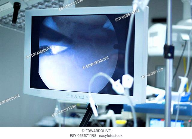 Hospital keyhole micro surgery arthroscopy operation screen showing arthroscope camera internal body image photo
