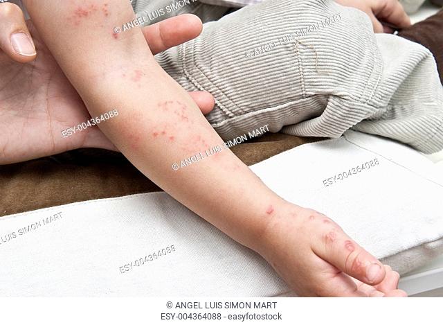 Herpes in a child arm