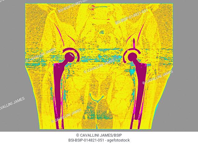 Complete hip prostheses (treatment for the destruction of hip cartilage through arthritis). Frontal pelvic CT scan