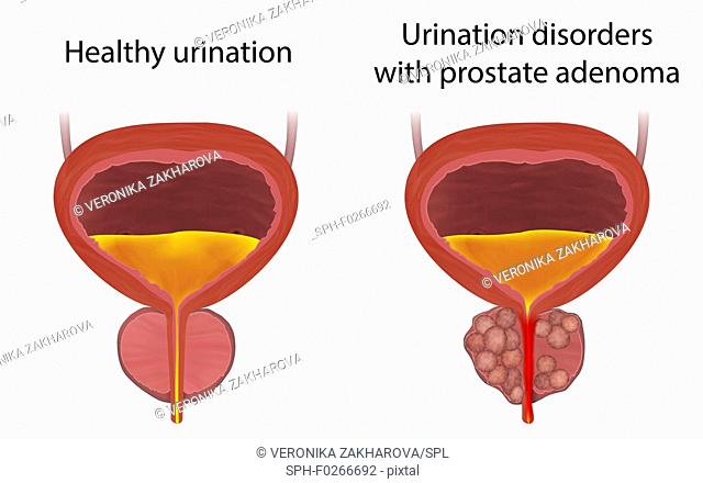 Comparison of urinary disorders with prostate adenoma and healthy urination, illustration