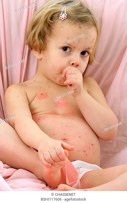 Model. 4-year-old girl affected by chickenpox disease