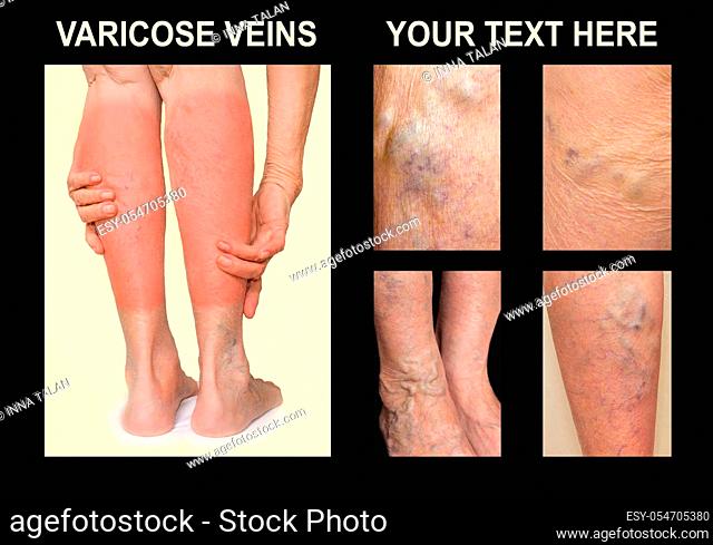 Painful varicose veins, , spider veins, varices on a female leg. Ageing, old age disease, aesthetic problem concept. Collage