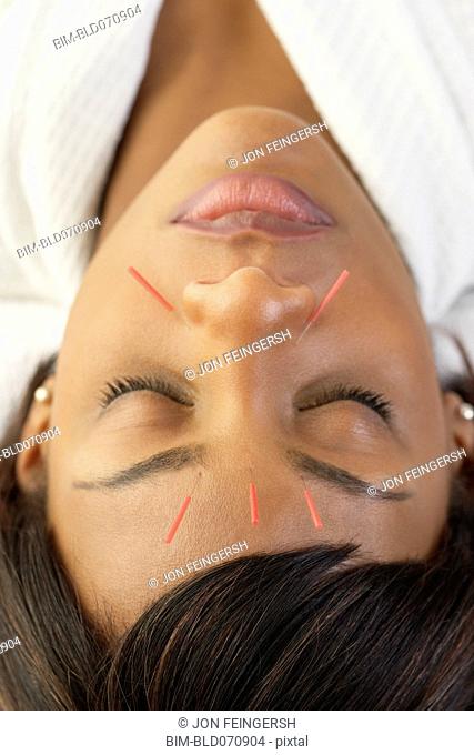 Acupuncture needles in African woman's face