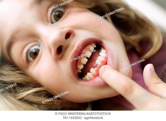Girl pointing chipped teeth