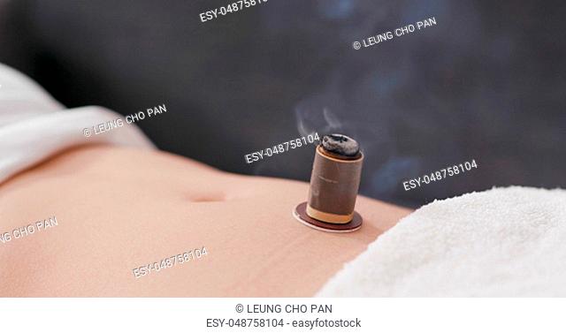 Traditional chinese medicine moxibustion therapy