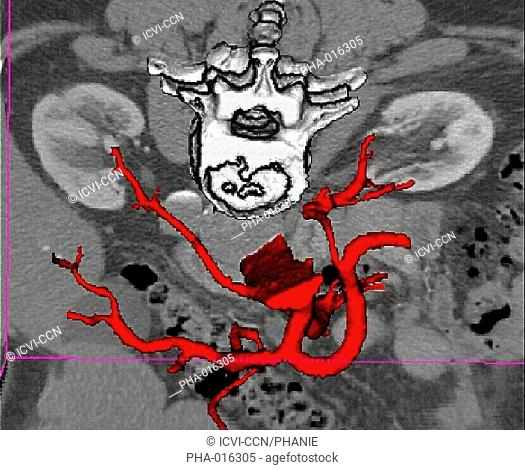 3D computed tomographic CT scan reconstruction of a dissecting aneurysm of the aorta that causes a left renal ischemia kidney infarctus