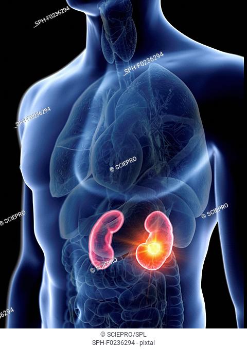 Illustration of a man's kidneys tumour