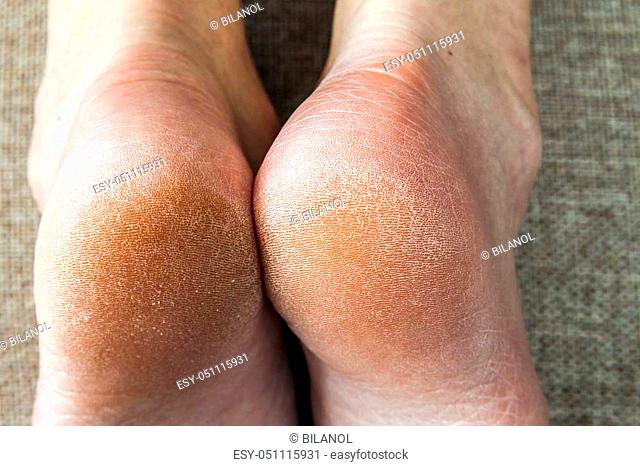 Dry cracked skin of woman feet in bed. Foot treatment