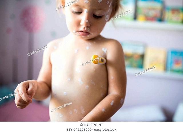 Little two year old girl at home sick with chickenpox, white antiseptic cream applied to the rash, measures the temperature with thermometer under her arm