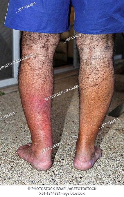 Erysipelas on leg  Close-up of swollen & inflamed skin of a young man  This is due to erysipelas, an acute infection of the skin & subcutaneous tissue  This...
