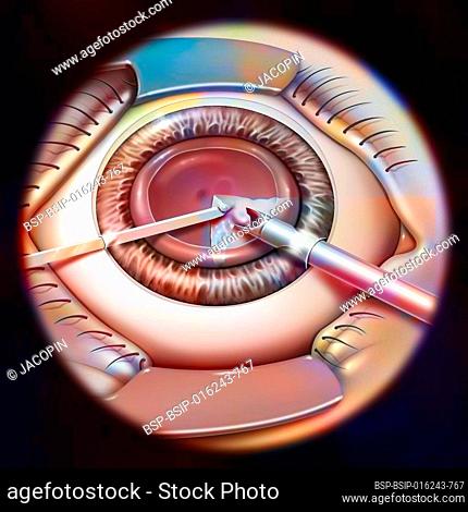 Eye, cataract, phacoemulsification - step 2: consists of breaking the lens with a probe