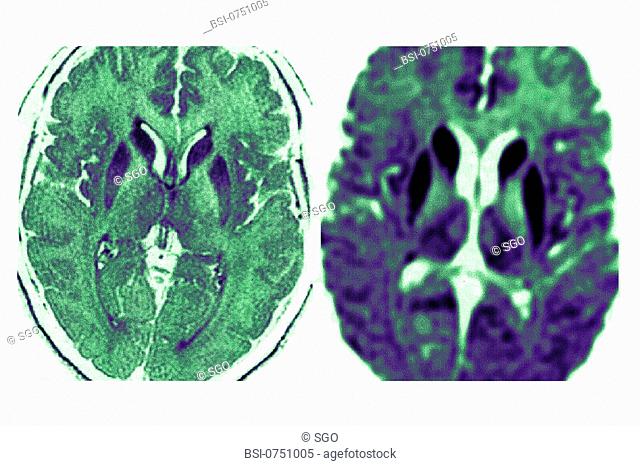 CREUTZFELDT JAKOB DISEASE, MRI<BR>Bilateral lesions of the caudate heads, the putamens, and the internal posterior region of the two thalami (image on the...
