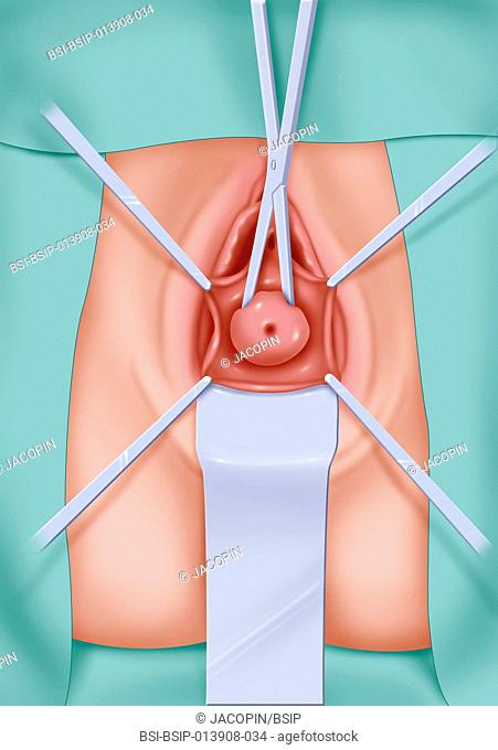 Illustration of a hysterectomy through the vagina, the uterus is extracted through natural channels
