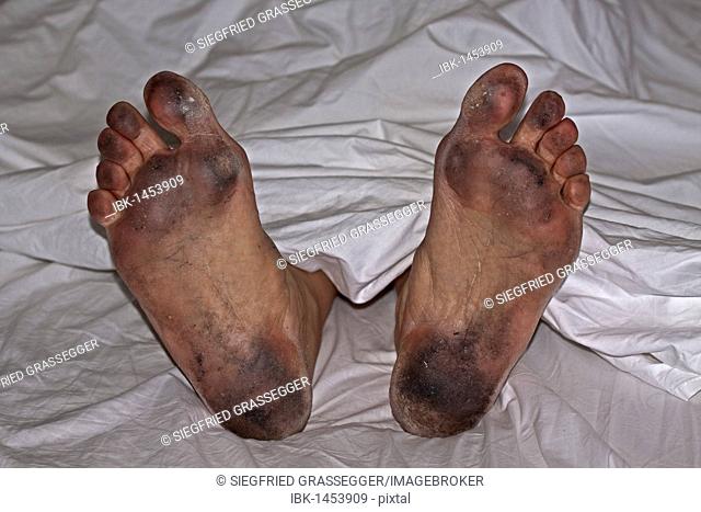 Ill-groomed dirty feet in white sheets, personal hygiene