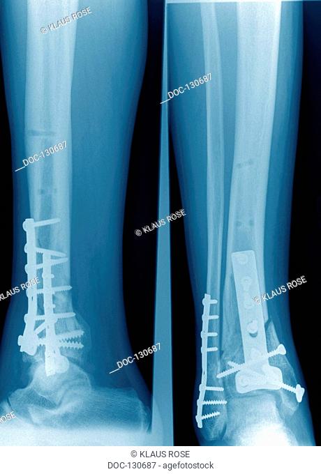 X-ray photographs of a surgical practice. fracture of the lower leg