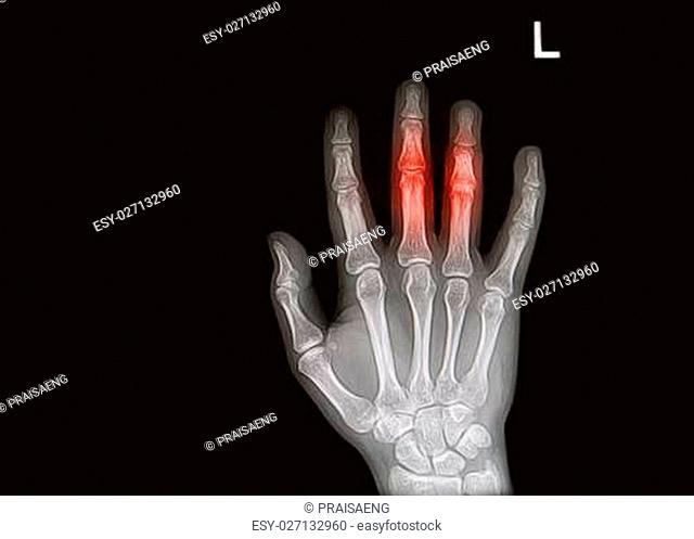 injury or painful of hand and finger x-rays image