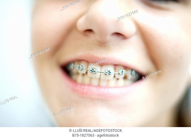 ortodoncia, primer plano de boca de chica adolescente con aparatos en los dientes, Orthodontics, mouth foreground teenage girl with braces on teeth