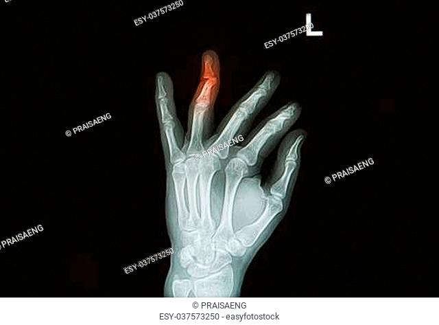 injury or painful of hand and finger x-rays image